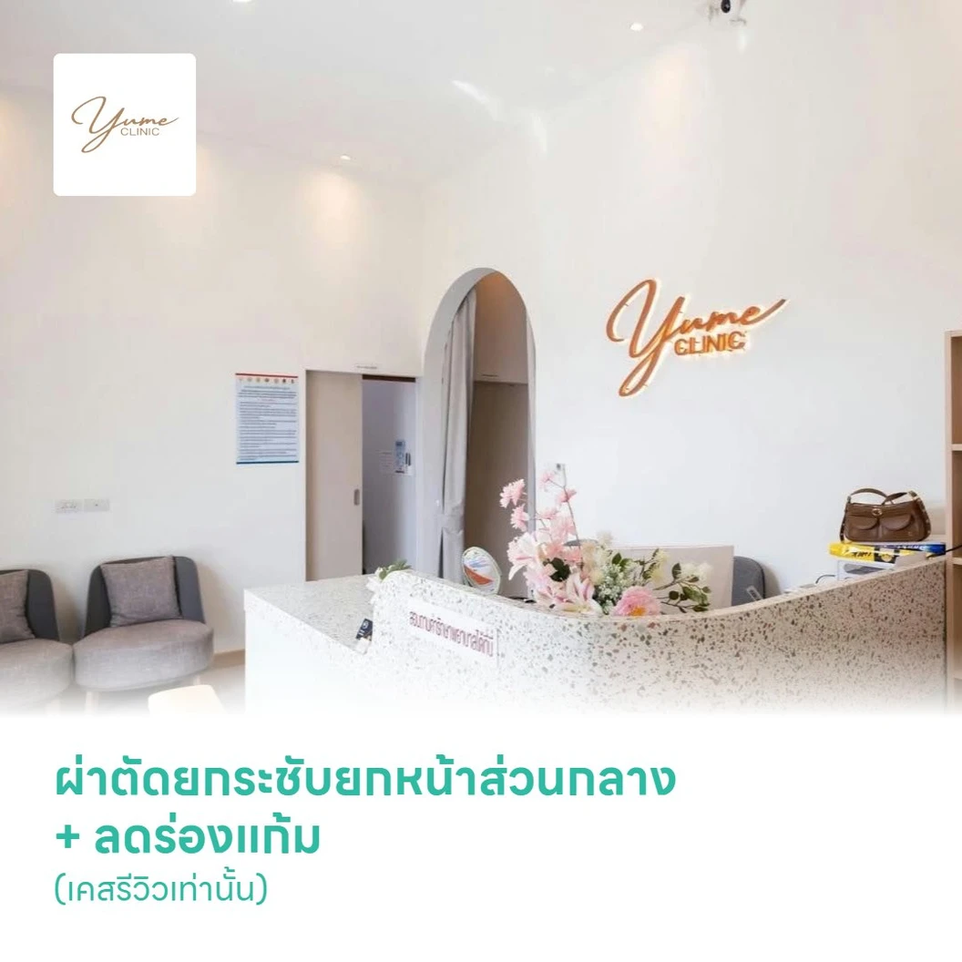 ผ่าตัดยกระชับยกหน้าส่วนกลาง + ลดร่องแก้ม (เคสรีวิวเท่านั้น)