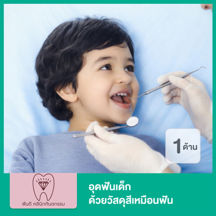อุดฟันเด็ก 1 ด้าน ด้วยวัสดุสีเหมือนฟัน ที่ ฟันดี คลินิกทันตกรรม - ราคา 2566  (2023) | Hdmall