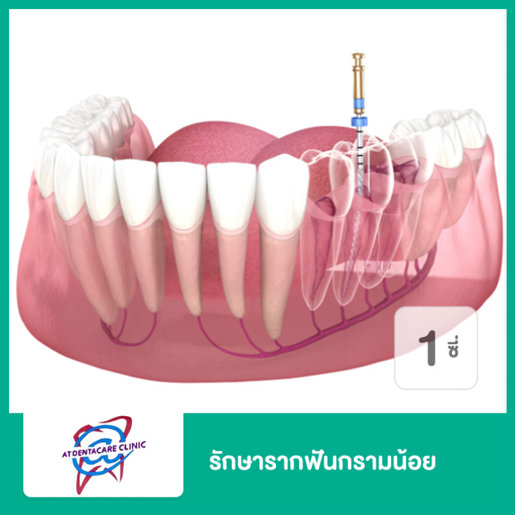 รักษารากฟันกรามน้อย 1 ซี่ ที่ แอทเดนต้าแคร์ คลินิกทันตกรรม - ราคา 2566  (2023) | Hdmall