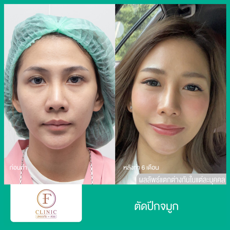 ตัดปีกจมูก ที่ F Clinic - ราคา 2566 (2023) | Hdmall