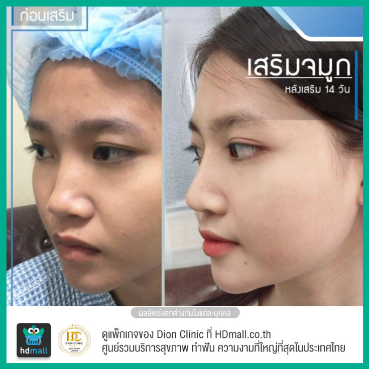 เสริมจมูกทรงสโลปปลายพุ่ง ซิลิโคนเกาหลี ที่ Dion Clinic - ราคา 2566 (2023) |  Hdmall