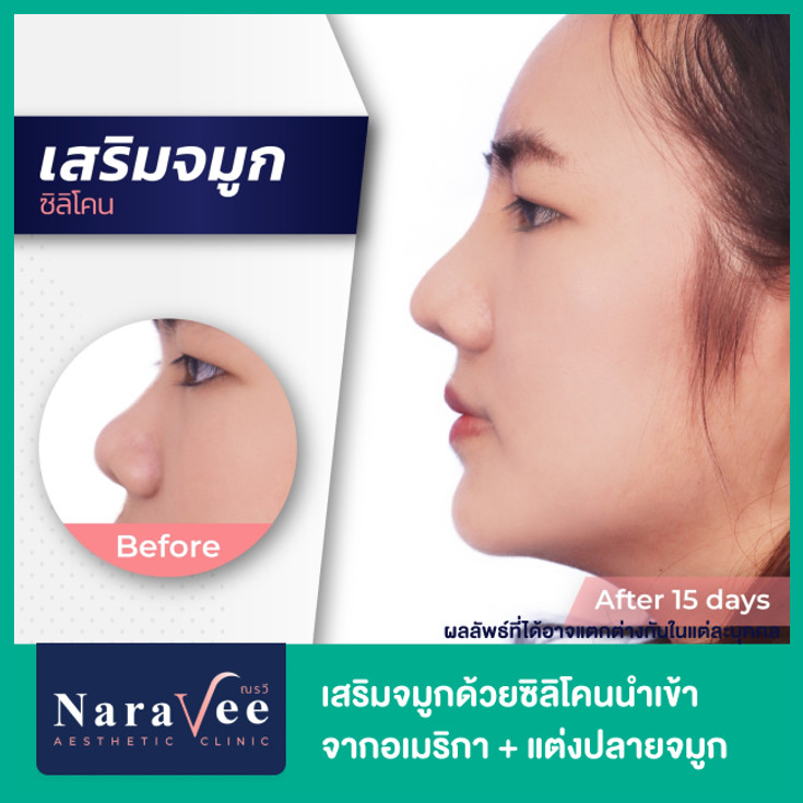 เสริมจมูกด้วยซิลิโคนนำเข้าจากอเมริกา + แต่งปลายจมูก 1 ครั้ง ที่ Naravee  Clinic (ณรวีคลินิก) - ราคา 2566 (2023) | Hdmall