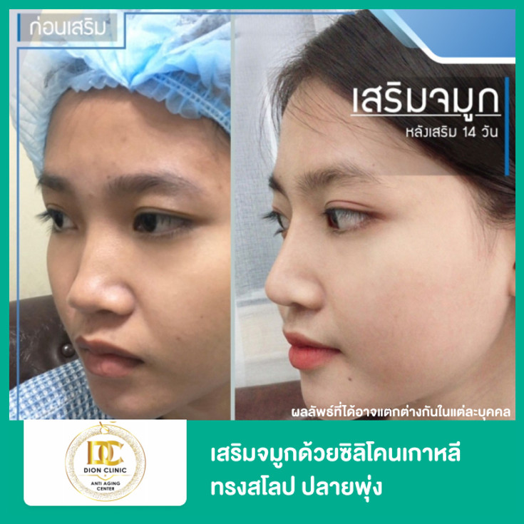 เสริมจมูกทรงสโลปปลายพุ่ง ซิลิโคนเกาหลี ที่ Dion Clinic - ราคา 2566 (2023) |  Hdmall