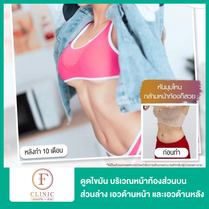 ดูดไขมัน บริเวณหน้าท้องส่วนบน ส่วนล่าง เอวด้านหน้า และเอวด้านหลัง 1 ครั้ง  ที่ F Clinic - ราคา 2566 (2023) | Hdmall