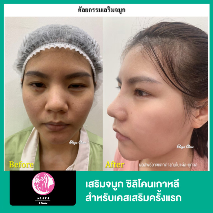 เสริมจมูก ซิลิโคนเกาหลี สำหรับเคสเสริมครั้งแรก ที่ Slayaclinic Thesquare  Bangyai - ราคา 2566 (2023) | Hdmall