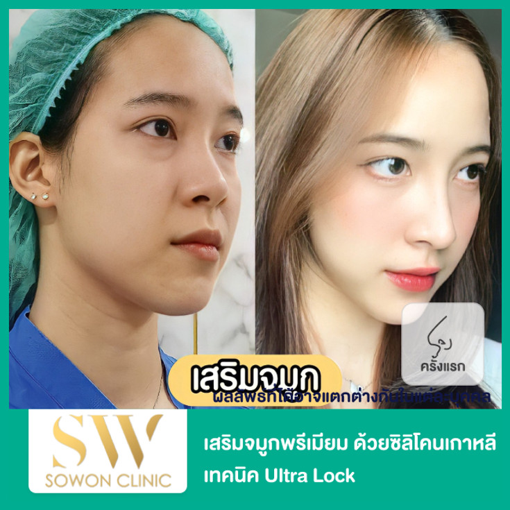 เสริมจมูกพรีเมียม ด้วยซิลิโคนเกาหลี เทคนิค Ultra Lock สำหรับเคสทำครั้งแรก  ที่ Sowon Clinic - ราคา 2566 (2023) | Hdmall