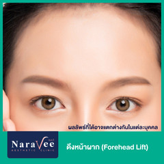 ดึงหน้าผาก (Forehead Lift) ด้วย Endotine ที่ Naravee Clinic (ณรวีคลินิก)