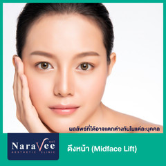 ดึงหน้า (Midface Lift) ด้วย Endotine ที่ Naravee Clinic (ณรวีคลินิก)