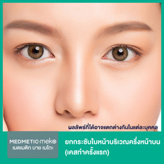 ยกกระชับใบหน้าบริเวณครึ่งหน้าบน ด้วยเทคนิค SOOF Lift สำหรับเคสทำครั้งแรก ที่ Medmetic by Meko