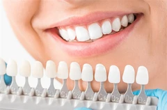 เคลือบผิวฟันและแปะฟันขาว ด้วยวีเนียร์คอมโพสิต 1 ซี่