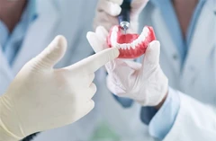 รักษารากฟันหน้า 1 ซี่ (ตามแพทย์ประเมิน)