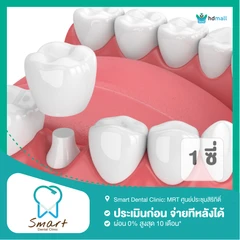 ทำครอบฟัน Zirconia สำหรับฟัน 1 ซี่
