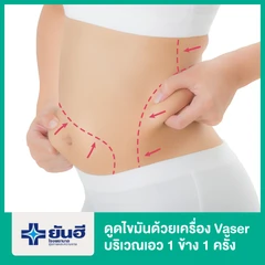 โปรแกรมดูดไขมันด้วยเครื่อง Vaser บริเวณเอว 1 ข้าง 1 ครั้ง