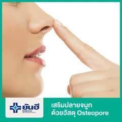 เสริมปลายจมูกด้วยวัสดุ Osteopore (เพิ่มจากเสริมจมูก)