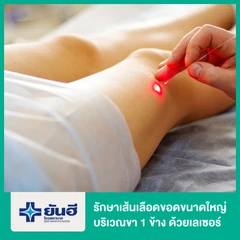 รักษาเส้นเลือดขอดขนาดใหญ่บริเวณขา 1 ข้าง ด้วยเลเซอร์