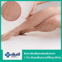 รักษาเส้นเลือดขอดบริเวณขา 1 ข้าง ด้วยคลื่นความถี่วิทยุ (RFA)