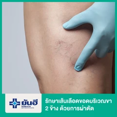 รักษาเส้นเลือดขอดบริเวณขา 2 ข้าง ด้วยการผ่าตัด