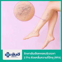 รักษาเส้นเลือดขอดบริเวณขา 2 ข้าง ด้วยคลื่นความถี่วิทยุ (RFA)