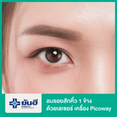ลบรอยสักคิ้ว 1 ข้าง ด้วยเลเซอร์ เครื่อง Picoway