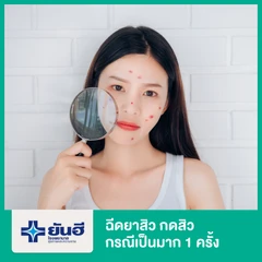 ฉีดยาสิว กดสิว กรณีเป็นมาก 1 ครั้ง