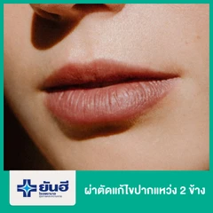 ผ่าตัดแก้ไขปากแหว่ง 2 ข้าง