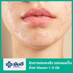 รักษารอยแดงจากสิว รอยแผลเป็น ด้วยเครื่อง Vbeam 1-5 ช็อตแรก