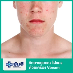 รักษารอยแดงไฝแดง ด้วยเครื่อง Vbeam 1 จุดแรก