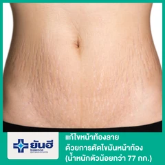 แก้ไขหน้าท้องลาย ด้วยการตัดไขมันหน้าท้อง (น้อยกว่า 70 กก.)