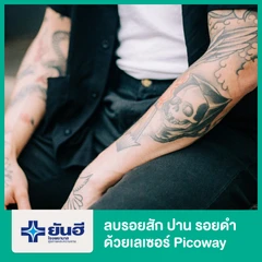 ลบรอยสักตัว ปาน รอยดำ ด้วยเลเซอร์ เครื่อง Picoway