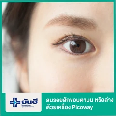 ลบรอยสักขอบตาบนหรือล่าง ด้วยเลเซอร์ เครื่อง Picoway