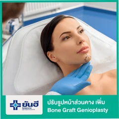 ปรับรูปหน้าส่วนคาง เพิ่ม Bone Graft Genioplasty