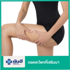 ถอดสะโพกที่เสริมมา พักรพ. 1 คืน