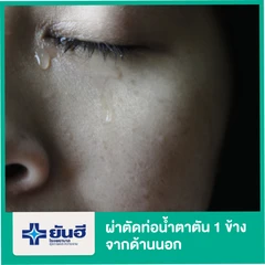 ผ่าตัดท่อน้ำตาตันจากด้านนอก สำหรับตา 1 ข้าง (ดมยา) นอนพักที่รพ. 1 คืน