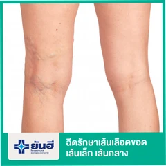 ฉีดรักษาเส้นเลือดขอด เส้นเล็ก เส้นกลาง