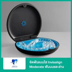 จัดฟันแบบใส Invisalign Moderate ฟันบนและล่าง