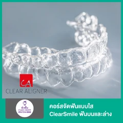 คอร์สจัดฟันแบบใส ClearSmile ฟันบนและล่าง