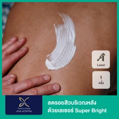 ลดรอยสิวบริเวณหลัง ด้วยเลเซอร์ Super Bright 1 ครั้ง