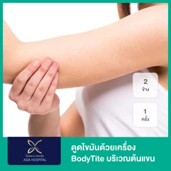 โปรแกรมดูดไขมันด้วยเครื่อง BodyTite บริเวณต้นแขน 2 ข้าง 1 ครั้ง