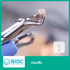 ถอนฟัน 1 ซี่