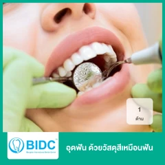 อุดฟัน 1 ด้าน ด้วยวัสดุสีเหมือนฟัน