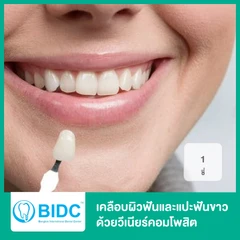 เคลือบผิวฟันและแปะฟันขาว ด้วยวีเนียร์คอมโพสิต 1 ซี่