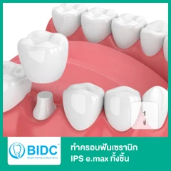 ทำครอบฟันเซรามิก IPS E.Max ทั้งชิ้น 1 ซี่