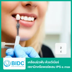 เคลือบผิวฟันและแปะฟันขาว ด้วยวีเนียร์เซรามิกหรือพอร์ซเลน IPS e.max 2 ซี่