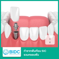 ทำรากฟันเทียม SIC รวมครอบฟัน 1 ซี่