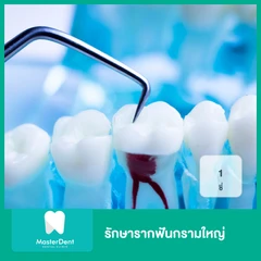 รักษารากฟันกรามใหญ่ 1 ซี่