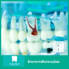 รักษารากฟันกรามน้อย 1 ซี่