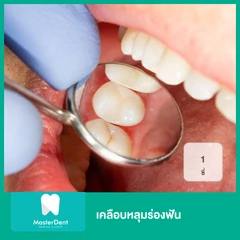 เคลือบหลุมร่องฟัน 1 ซี่