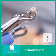 ถอนฟันอย่างยาก 1 ซี่