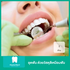 อุดฟัน 1 ด้าน ด้วยวัสดุสีเหมือนฟัน