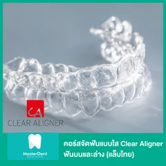 คอร์สจัดฟันแบบใส Clear Aligner ฟันบนหรือล่าง (แล็บไทย)
